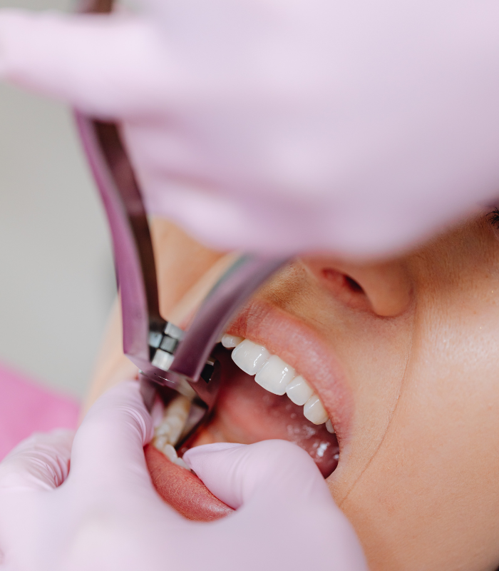 Tooth extraction